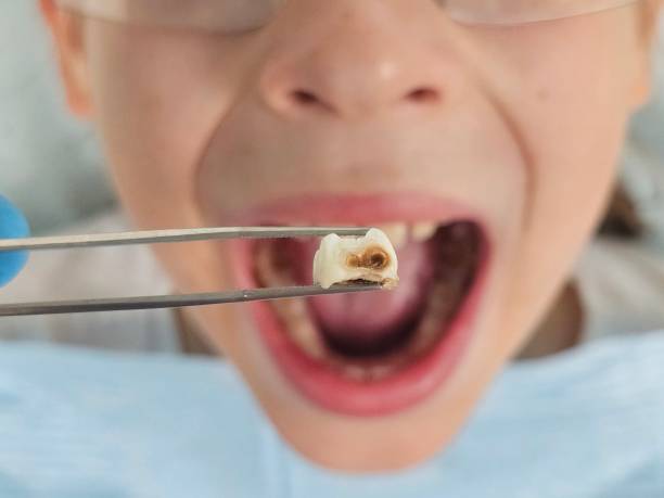 Best Emergency Tooth Extraction in Dahlgren, VA